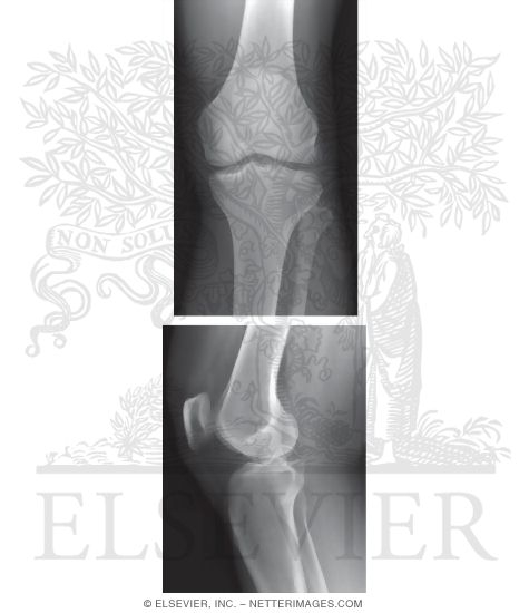 Knee Joint X-Ray 