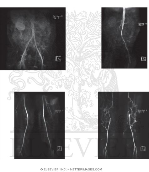 Vascular Studies of the Lower Extremity: Magnetic Resonance Angiography (MRA) of the Thigh