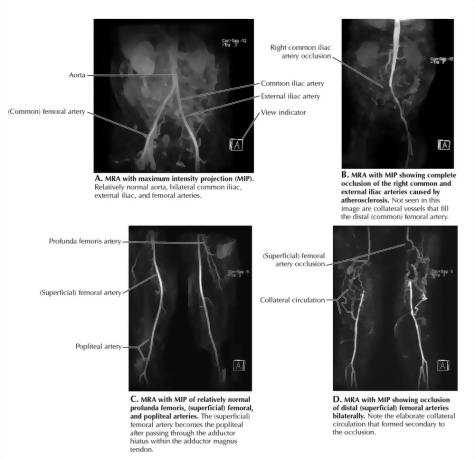 Vascular Studies of the Lower Extremity: Magnetic Resonance Angiography (MRA) of the Thigh