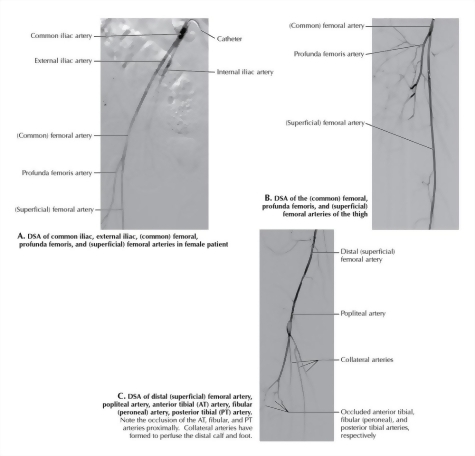Digital Subtraction Angiography (DSA) of the Right Lower Extremity