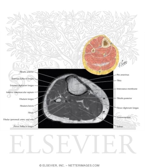 Axial T1 MRI Through the Leg 