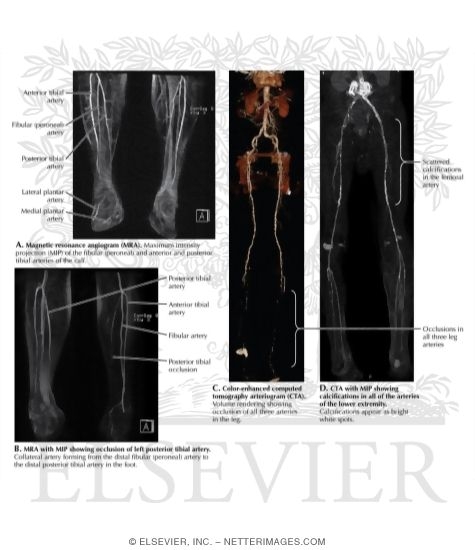Vascular Studies of the Lower Extremity: CTA/MRA of the Leg and Lower Extremities