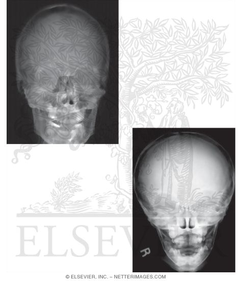 Skull: A-P Radiograph 