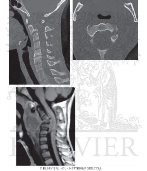 Watermarked preview of unlabeled image: Imaging of Cervical Trauma and Pathology