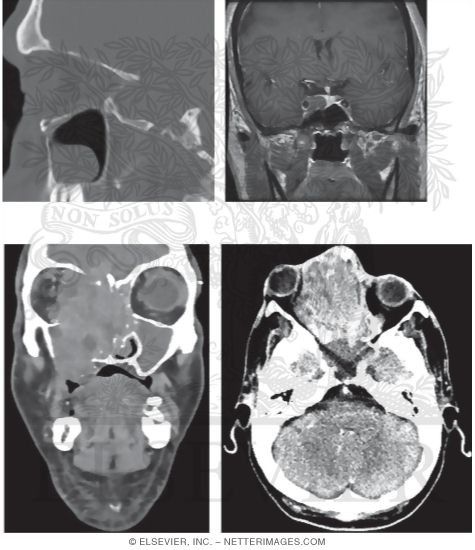 Watermarked preview of unlabeled image: Imaging of Sinus and Orbit Pathology 