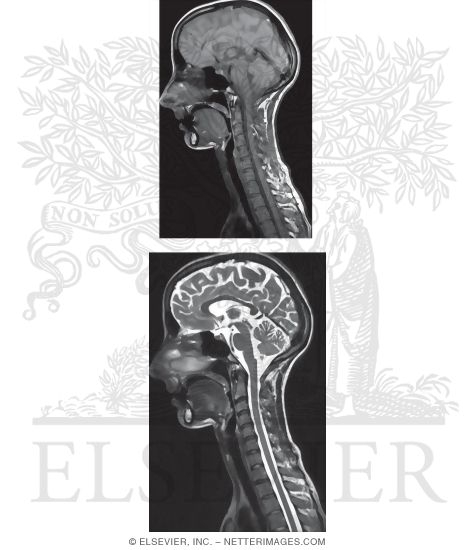 T1 and T2 MRI of the Head and Neck in Midsagittal Section