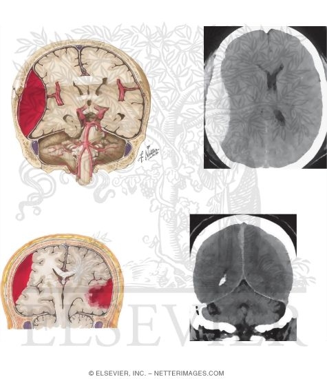 Imaging of Epidural and Subdural Bleeding