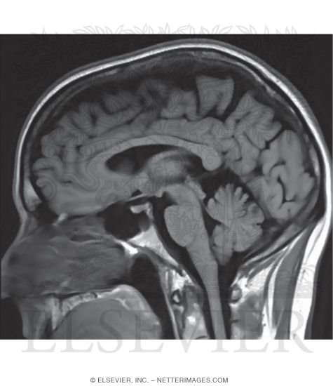 Watermarked preview of unlabeled image: Midsagittal T1 MRI 