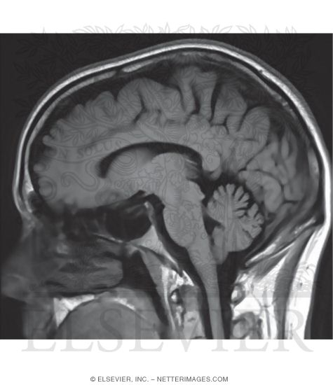 T1 Sagittal MRI 