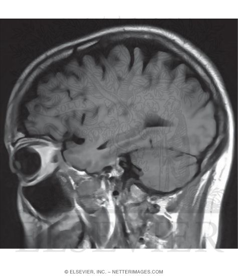 T1 Sagittal MRI Through the Temporal Lobe