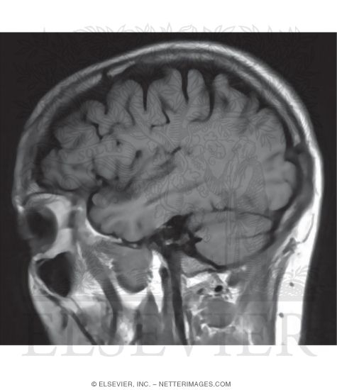 T1 Sagittal MRI Through the Temporal Lobe