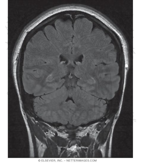 Watermarked preview of unlabeled image: T2 FLAIR Coronal MRI Through the Cerebellum 