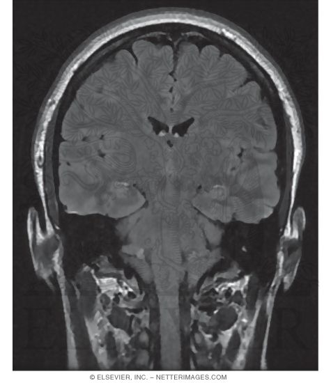 T2 FLAIR Coronal MRI Through the Brainstem
