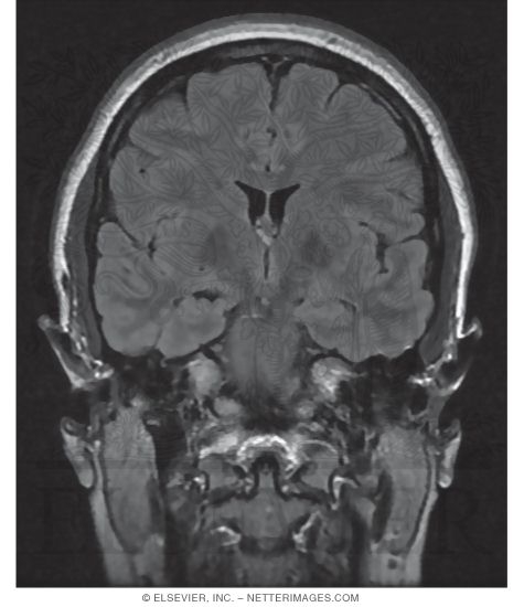 T2 FLAIR Coronal MRI Through the Pons and 3rd Ventricle