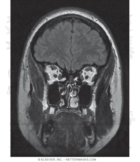 Watermarked preview of unlabeled image: T2 FLAIR Coronal MRI Through the Frontal Lobes 