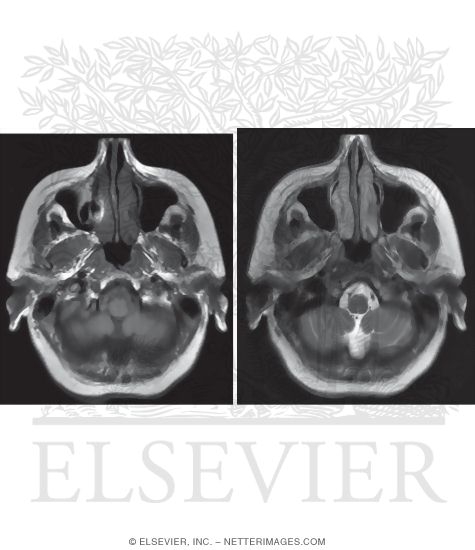 T1 and T2 Axial MRI Through the Medulla Oblongata 