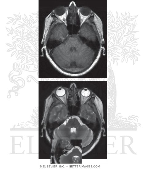 T1 and T2 Axial MRI Through the Cerebellum, Temporal Lobes, and Eye