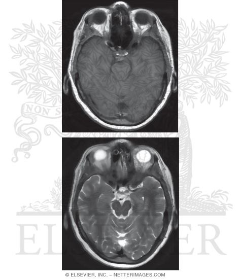 T1 and T2 Axial MRI Through the Upper Cerebellum