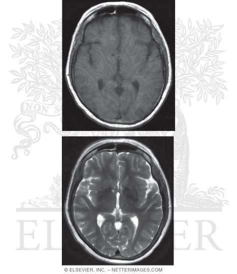Watermarked preview of unlabeled image: T1 and T2 Axial MRI Through the Thalamus and 3rd Ventricle 