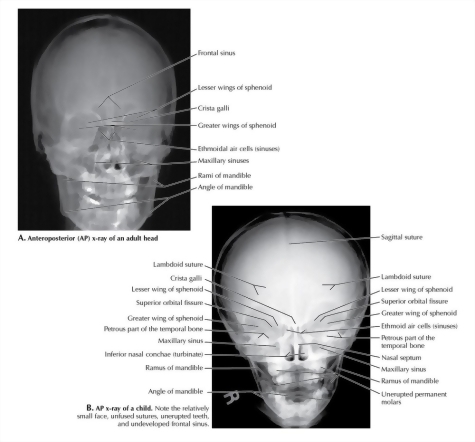 Skull: A-P Radiograph 