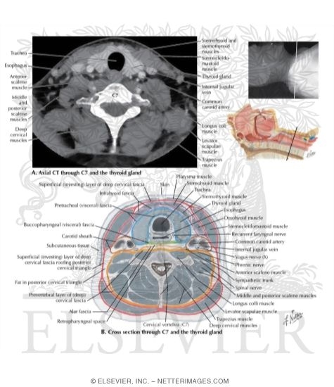 Axial CT and Cross Section of Neck Through C7 and the Thyroid Gland