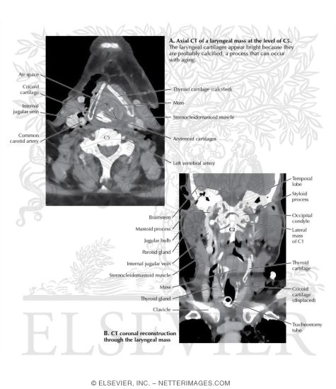 Laryngeal cancer pathophysiology image