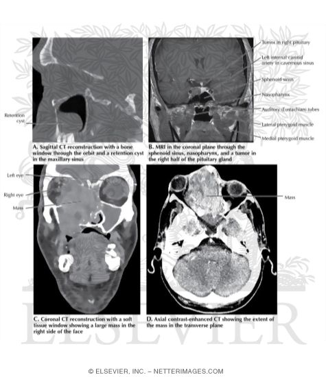 Watermarked preview of labeled image: Imaging of Sinus and Orbit Pathology 