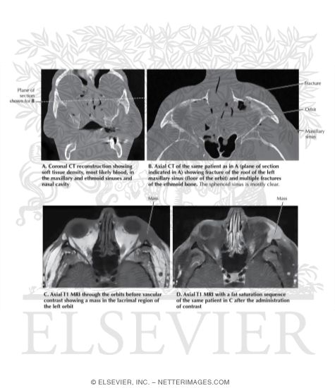 Watermarked preview of labeled image: Imaging of Sinus and Orbit Pathology 