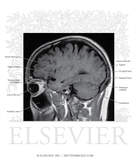 T1 Sagittal MRI Through the Temporal Lobe