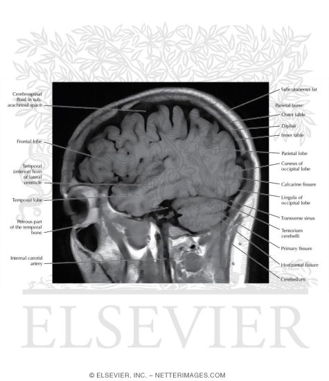 T1 Sagittal MRI Through the Temporal Lobe