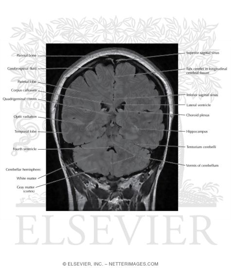 Watermarked preview of labeled image: T2 FLAIR Coronal MRI Through the Cerebellum 