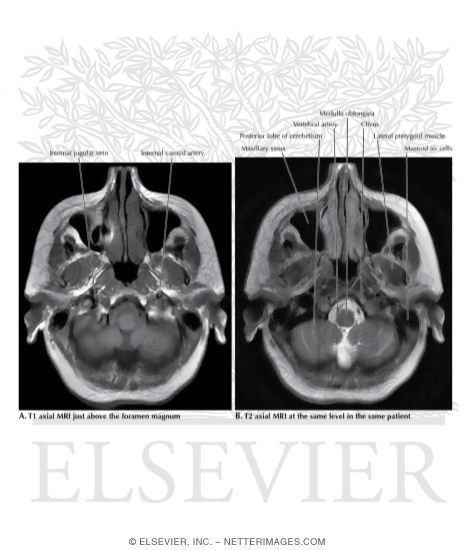 T1 and T2 Axial MRI Through the Medulla Oblongata