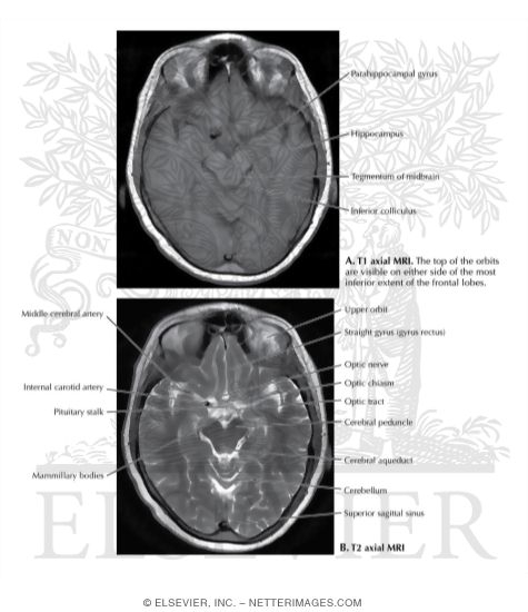 T1 and T2 Axial MRI Through the Optic Chiasm