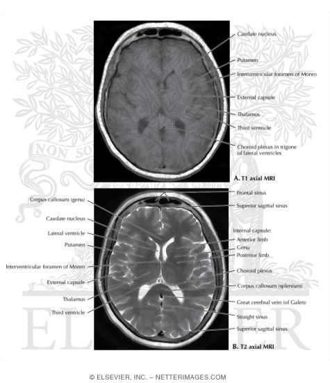 T1 and T2 Axial MRI Through the Thalamus and Lateral Ventricles