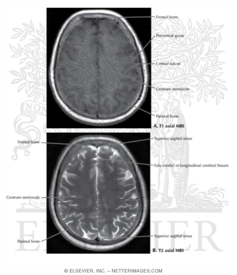 T1 and T2 Axial MRI Through the Middle of the Cerebral Hemispheres