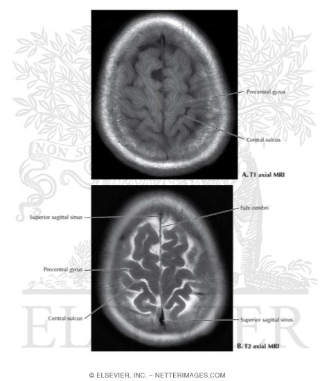 T1 and T2 Axial MRI Through the Thalamus and Lateral Ventricles