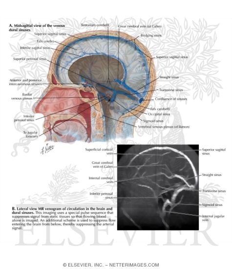 Dural Venous Sinuses
