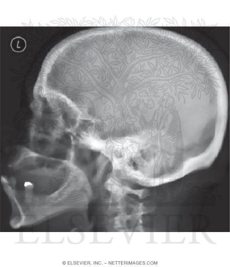 Lateral X-Ray of Head