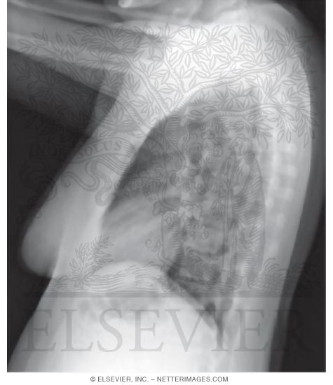 Lateral X-Ray of Thorax