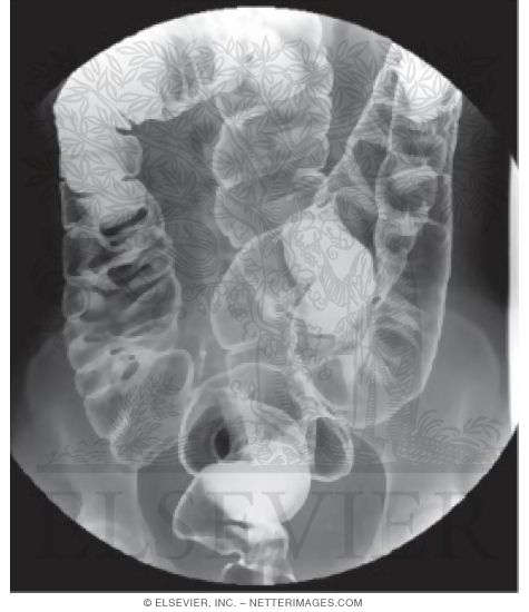 Watermarked preview of unlabeled image: Colon Double Contrast Study