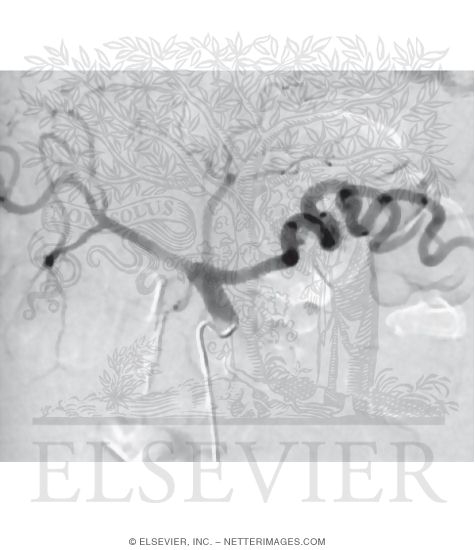 Watermarked preview of unlabeled image: Celiac Arteriogram