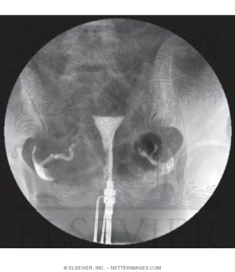 Hysterosalpingogram