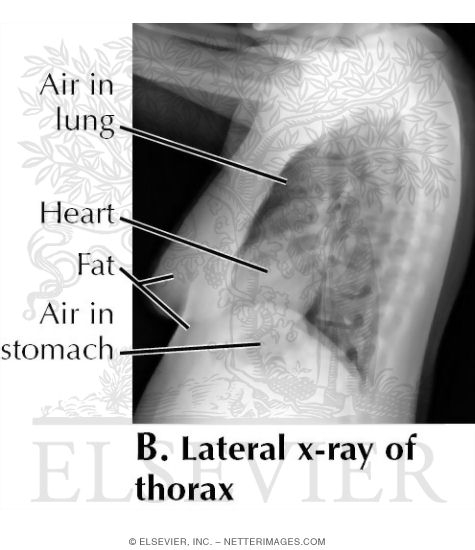 Lateral X-Ray of Thorax