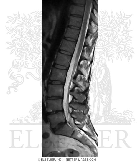 Midsagittal T2 MRI In the Lumbosacral Region