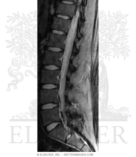 Parasagittal T2 Fat Saturation MRI In the Lumbosacral Region