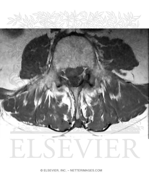 Axial (Transverse) T1 MRI