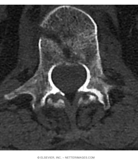 Axial CT With a Bone Window Setting