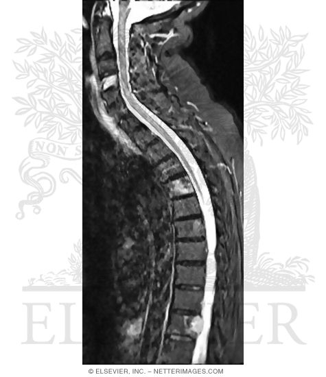 Sagittal T2 STIR (Fat Saturation) MRI