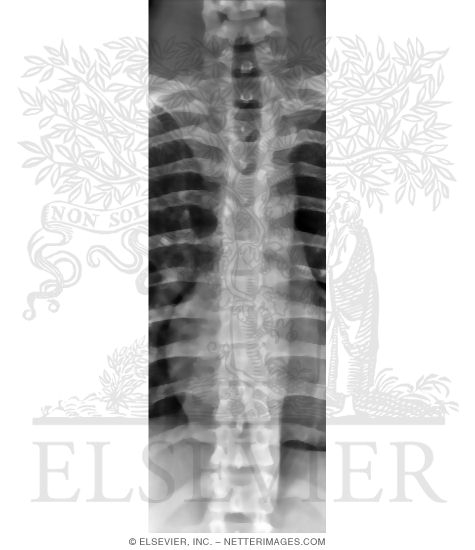 Anteroposterior X-Ray of the Thoracic Spine