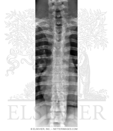 Anteroposterior X-Ray of the Thoracic Spine
